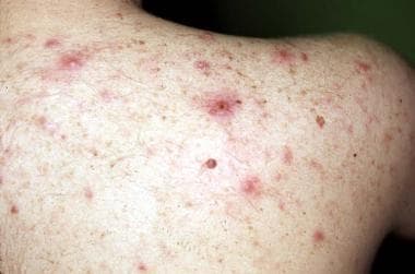 Lesions of steroid-induced acne (evident on the ba