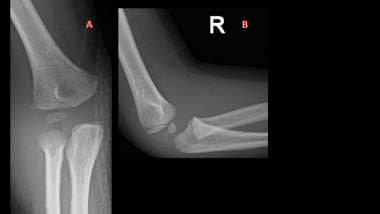 Supracondylar Humeral Fracture - Physiopedia