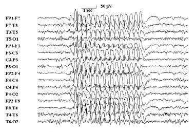 典型的3赫兹脑电图峰值和波