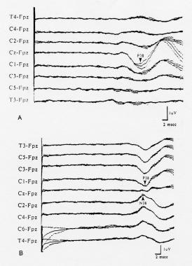 Cortical somatosensory evoked potentials (SEPs) to