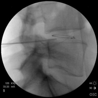 Lateral fluoroscopy view shows the catheter around