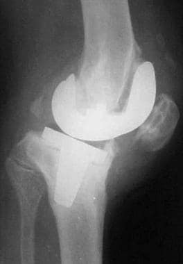 Lateral radiograph showing lysis and loosening of 