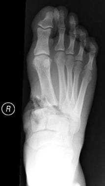 midfoot fracture