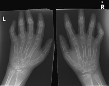 Widespread osteopenia, carpal crowding (due to car