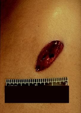 A "gaping" stab wound. Note that it is difficult t