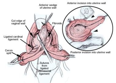 hysterectomy anatomy