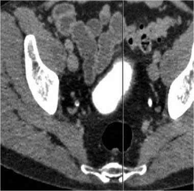 CT urogram: Axial image obtained in the excretory 