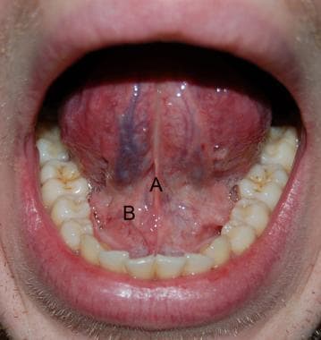 Floor of mouth. A: lingual frenulum; B: sublingual