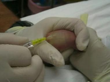 Flashback of blood into venous access device for p