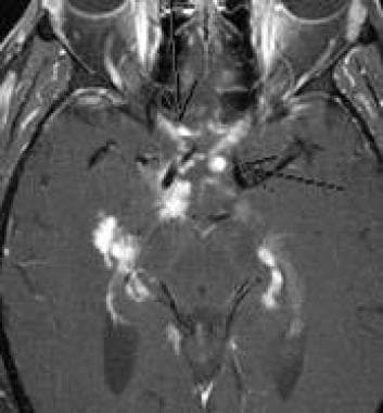 Neurosarcoidosis. Axial basal meninges and coronal