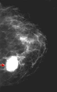 Percutaneous Removal of Postbiopsy Marking Clip in the Breast Using  Stereotactic Technique