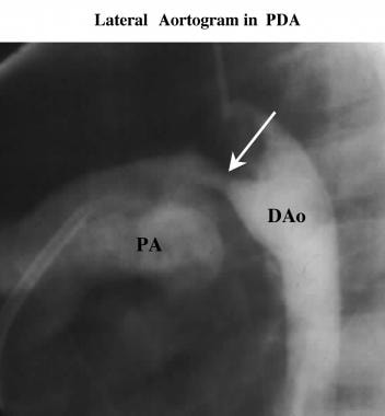 Lateral aortogram. This image demonstrates the con