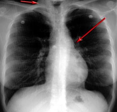 Posteroanterior chest radiograph demonstrates a pn