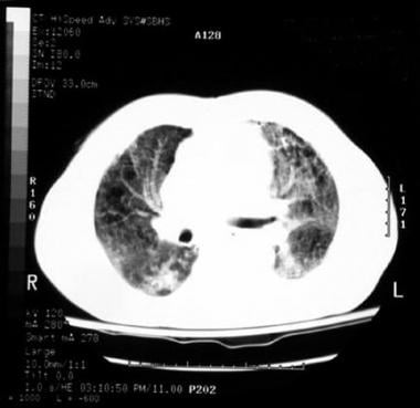 Amiodarone lung. CT image shows nearly diffuse gro