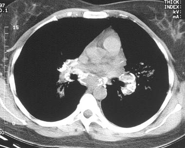 Sarcoidosis, thoracic. Axial CT scan through the m