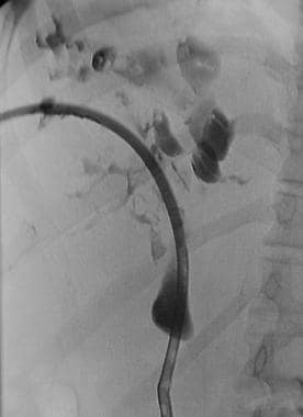 Percutaneous transhepatic cholangiographic image o