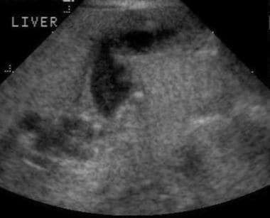 Diagnostic sonogram demonstrating a type I choledo