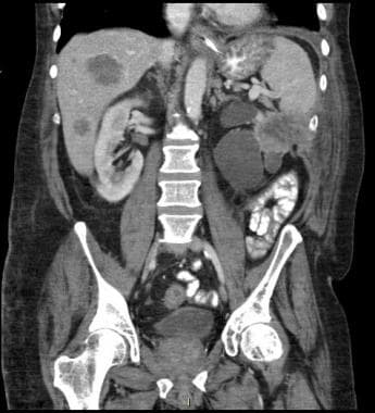 Recurrence of tumor in the peritoneal cavity, with