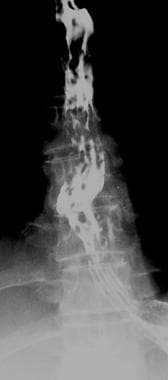 Uphill esophageal varices on barium swallow. 