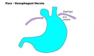 This diagram of a paraesophageal hiatal hernia sho