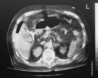 Pneumoperitoneum. Contrast-enhanced axial CT scan 