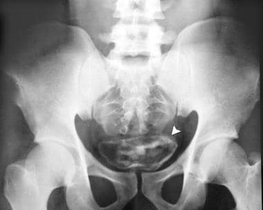 Plain abdominal radiograph in a 26-year-old man sh