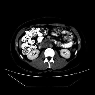 计算机断层扫描(CT)和超声波扫描