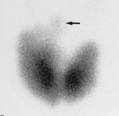 Technetium-99m pertechnetate thyroid scan demonstr