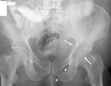 T-shaped acetabular fracture. An anteroposterior r