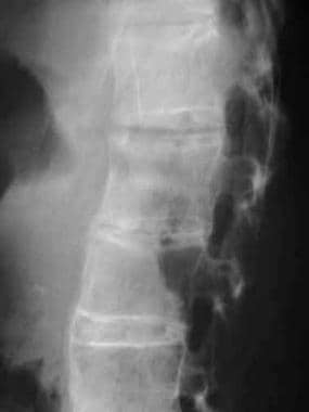 Disk calcification. Lateral radiograph shows L2-L3