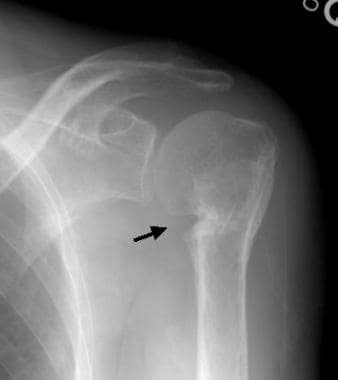 Anteroposterior radiographic view of the left shou