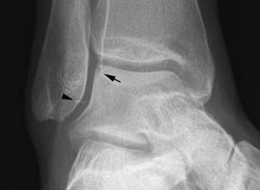 Mortise view of the ankle demonstrates a linear ca
