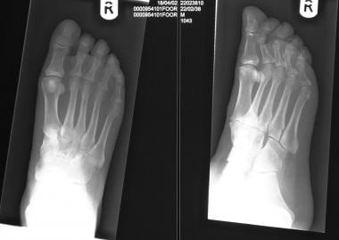 Osteomyelitis, chronic. Radiographs of the foot of