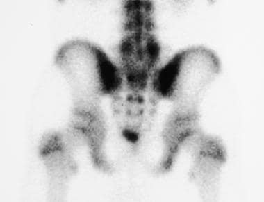 Spondylolisthesis. Planar image of lumbar spine in