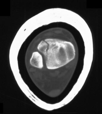 Axial computed tomography section in an 11-year-ol