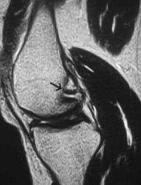 Sagittal T2-weighted image shows the normal femora