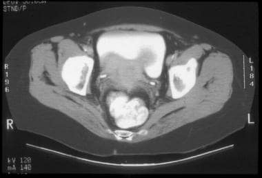 CT of clinical stage IIB cervical carcinoma (same 