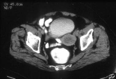 A 76-year-old woman with poorly differentiated end