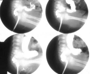 Hirschsprung disease. Barium enema technique shows