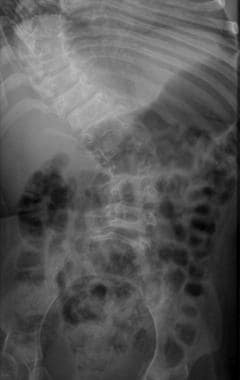 Frontal radiograph in a patient with type III oste