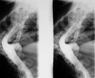 Myelograms in a 5-year-old patient show the dorsal