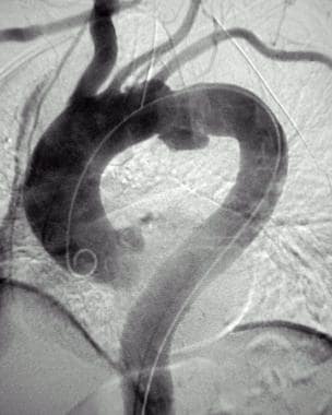 Digital subtraction catheter aortogram (late phase