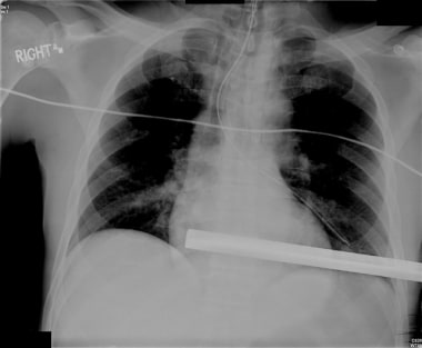 Nasogastric tube in lung. 
