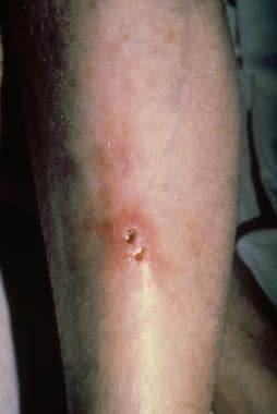 Ulceroglandular tularemia on an extremity. Courtes