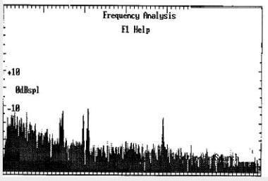 An example of multifrequency spontaneous otoacoust