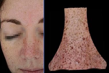 Emage Medical Image Pro II, skin pores. Courtesy o