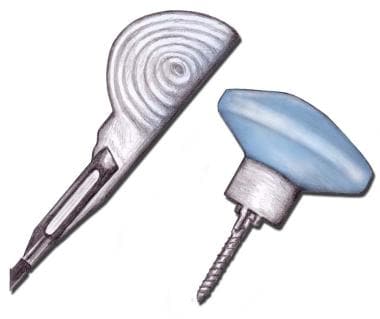Cook-type screw-tip intraosseous needle (Sur-Fast 