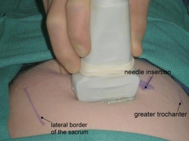Ultrasound-guided piriformis injection. Greater tr