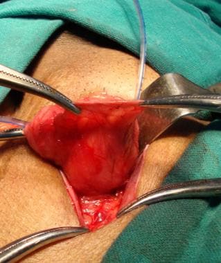 Open inguinal hernia repair. Cremaster muscle pick