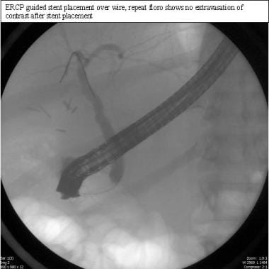 Laparoscopic cholecystectomy. ERCP-guided stent pl